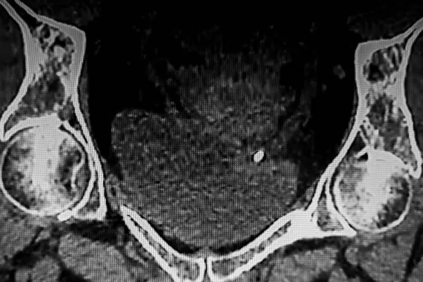 Lithiase : formation de petits calculs dans la vésicule biliaire, les reins ou les glandes salivaires à Bellignat
